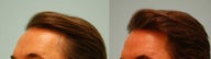 Hair Transplant