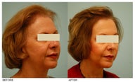Female Hair Transplant