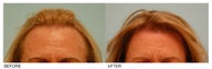 Female Hair Transplant