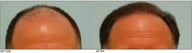 Hair Transplant