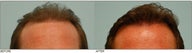 Hair Transplant