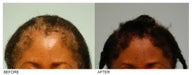 Female Hair Transplant