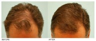 Hair Transplant