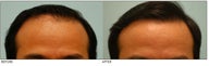 Hair Transplant