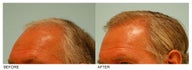 Hair Transplant
