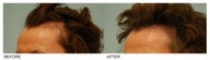 Female Hair Transplant