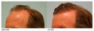 Hair Transplant