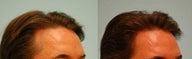 Hair Transplant