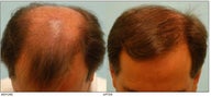 Hair Transplant