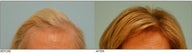 Female Hair Transplant