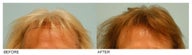 Female Hair Transplant