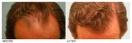 Hair Transplant