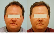 Hair Transplant