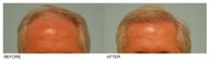 Hair Transplant