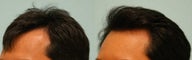 Hair Transplant