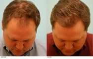 Hair Transplant