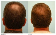 Crown (Vertex) Hair Transplant