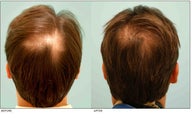 Crown (Vertex) Hair Transplant