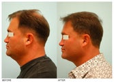 Crown (Vertex) Hair Transplant
