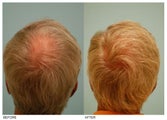 Crown (Vertex) Hair Transplant