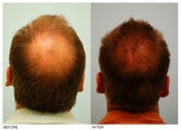 Crown (Vertex) Hair Transplant