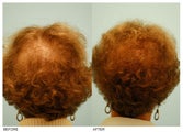 Crown (Vertex) Hair Transplant