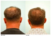 Crown (Vertex) Hair Transplant