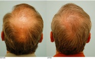Crown (Vertex) Hair Transplant