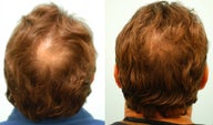 Crown (Vertex) Hair Transplant