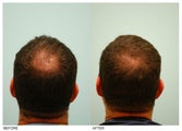 Crown (Vertex) Hair Transplant