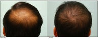 Crown (Vertex) Hair Transplant