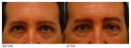 Eyebrow Hair Transplant
