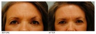 Eyebrow Hair Transplant