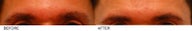 Eyebrow Hair Transplant