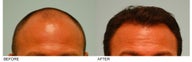 Hair Transplant