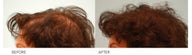 Female Hair Transplant