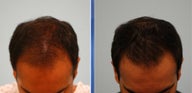Hair Transplant