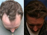 Hair Transplant