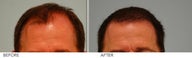 Hair Transplant