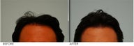 Corrective Hair Transplant