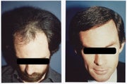 Hair Transplant