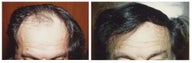 Hair Transplant