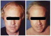 hair transplant