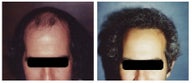 hair transplant