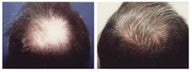 hair transplant