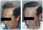 hair transplant