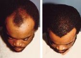 hair transplant