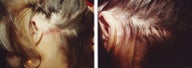 female hair transplant