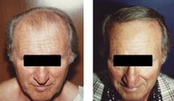 hair transplant