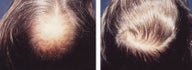 hair transplant